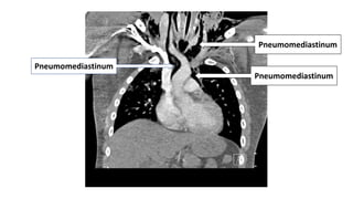 Pneumomediastinum
Pneumomediastinum
Pneumomediastinum
 