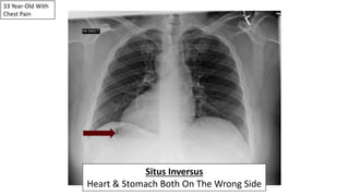 33 Year-Old With
Chest Pain
Situs Inversus
Heart & Stomach Both On The Wrong Side
 