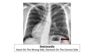 Dextrocardia
Heart On The Wrong Side, Stomach On The Correct Side
 