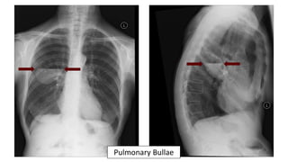 Pulmonary Bullae
 