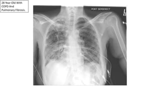 28 Year-Old With
COPD And
Pulmonary Fibrosis.
 