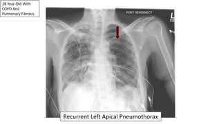 28 Year-Old With
COPD And
Pulmonary Fibrosis.
Recurrent Left Apical Pneumothorax
 