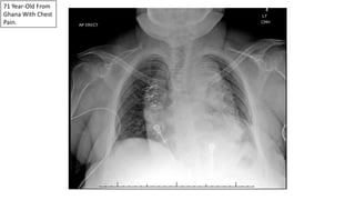 71 Year-Old From
Ghana With Chest
Pain.
 