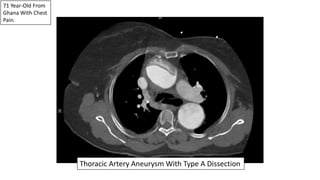 71 Year-Old From
Ghana With Chest
Pain.
Thoracic Artery Aneurysm With Type A Dissection
 