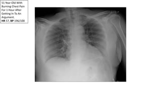 51 Year-Old With
Burning Chest Pain
For 1 Hour After
Getting In To An
Argument.
HR 57, BP 196/100
 