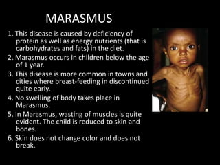 MARASMUS
1. This disease is caused by deficiency of
   protein as well as energy nutrients (that is
   carbohydrates and fats) in the diet.
2. Marasmus occurs in children below the age
   of 1 year.
3. This disease is more common in towns and
   cities where breast-feeding in discontinued
   quite early.
4. No swelling of body takes place in
   Marasmus.
5. In Marasmus, wasting of muscles is quite
   evident. The child is reduced to skin and
   bones.
6. Skin does not change color and does not
   break.
 