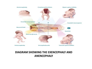 Exencephaly Week 3-8 - Teratology of Embryonic week pptx | PPTX