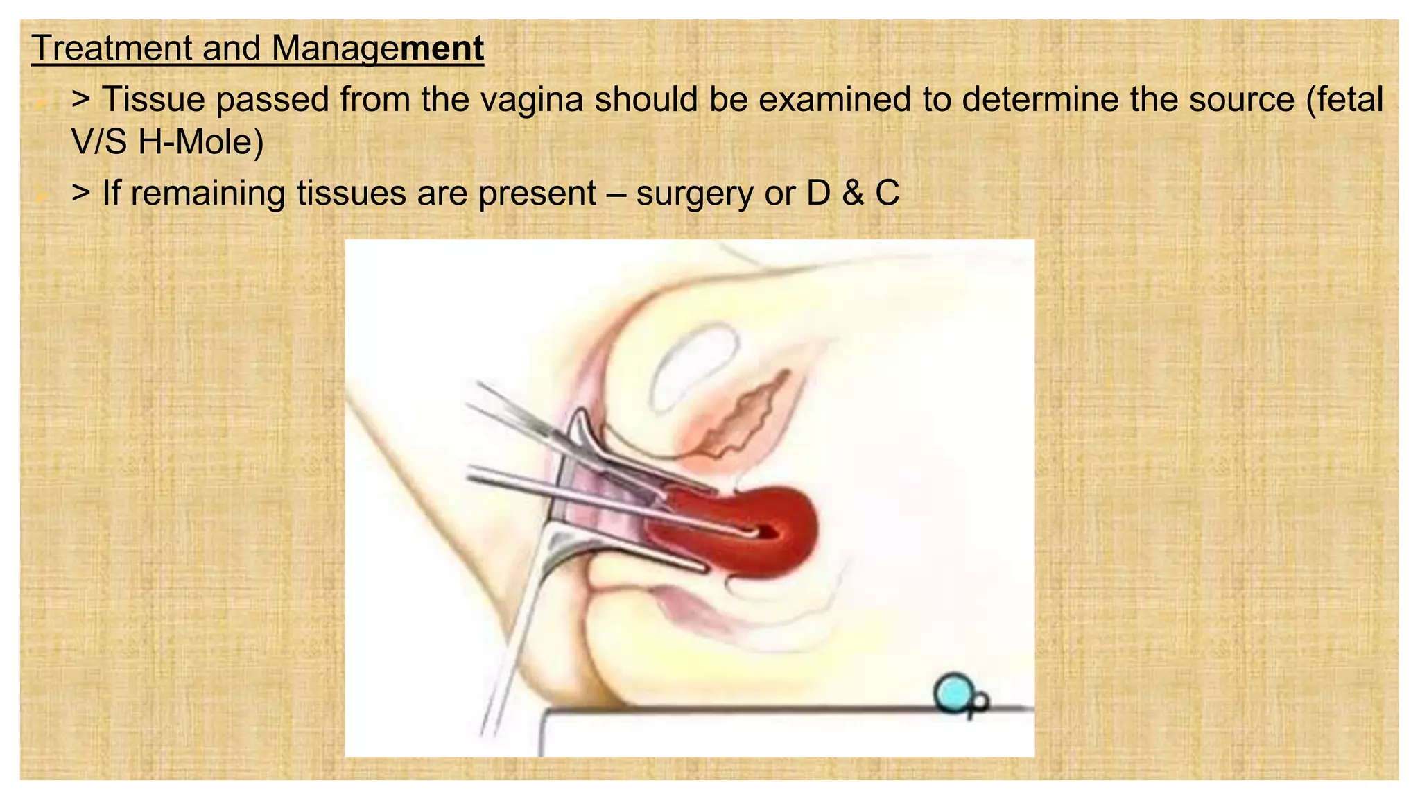 Treatment and Management
 > Tissue passed from the vagina should be examined to determine the source (fetal
V/S H-Mole)
 > If remaining tissues are present – surgery or D & C
 