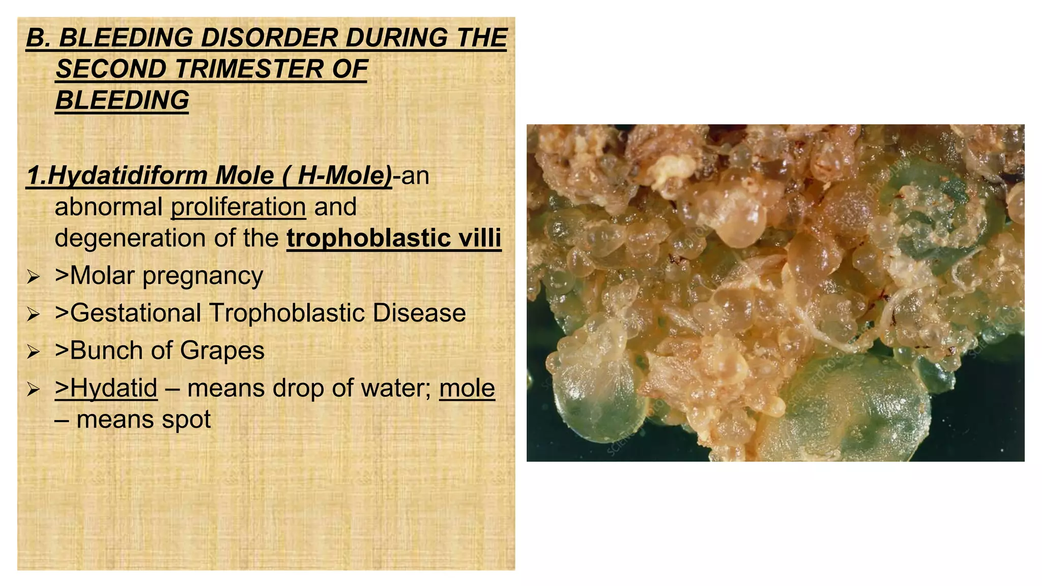B. BLEEDING DISORDER DURING THE
SECOND TRIMESTER OF
BLEEDING
1.Hydatidiform Mole ( H-Mole)-an
abnormal proliferation and
degeneration of the trophoblastic villi
 >Molar pregnancy
 >Gestational Trophoblastic Disease
 >Bunch of Grapes
 >Hydatid – means drop of water; mole
– means spot
 