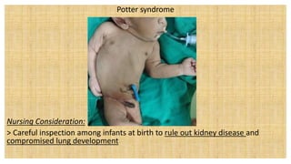 Potter syndrome
Nursing Consideration:
> Careful inspection among infants at birth to rule out kidney disease and
compromised lung development
 