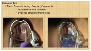 Signs and Test
 1. Pelvic Exam – thinning of cervix (effacement)
* Increased cervical dilatation
* Evidence of rupture membranes
 