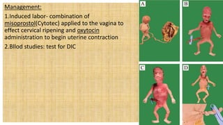 Management:
1.Induced labor- combination of
misoprostol(Cytotec) applied to the vagina to
effect cervical ripening and oxytocin
administration to begin uterine contraction
2.Bllod studies: test for DIC
 