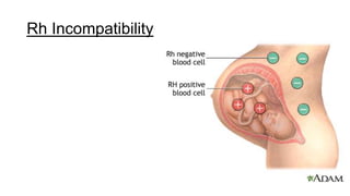 Rh Incompatibility
 