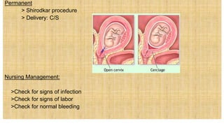 Permanent
> Shirodkar procedure
> Delivery: C/S
Nursing Management:
 >Check for signs of infection
 >Check for signs of labor
 >Check for normal bleeding
 