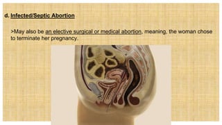 d. Infected/Septic Abortion
 >May also be an elective surgical or medical abortion, meaning, the woman chose
to terminate her pregnancy.
 