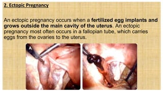 2. Ectopic Pregnancy
An ectopic pregnancy occurs when a fertilized egg implants and
grows outside the main cavity of the uterus. An ectopic
pregnancy most often occurs in a fallopian tube, which carries
eggs from the ovaries to the uterus.
 