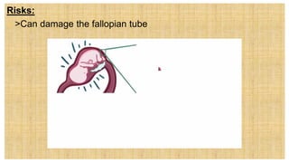 Risks:
 >Can damage the fallopian tube
 