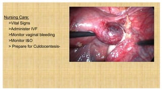 Nursing Care:
 >Vital Signs
 >Administer IVF
 >Monitor vaginal bleeding
 >Monitor I&O
 > Prepare for Culdocentesis-
 