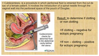 > Culdocentesis- is a procedure in which peritoneal fluid is obtained from the cul de
sac of a female patient. It involves the introduction of a spinal needle through the
vaginal wall into the peritoneal space of the pouch of Douglas
Result: to determine if clotting
or non clotting
 >If clotting – negative for
ectopic pregnancy
 >If non – clotting – positive
for ectopic pregnancy
 