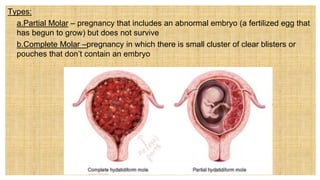 Types:
 a.Partial Molar – pregnancy that includes an abnormal embryo (a fertilized egg that
has begun to grow) but does not survive
 b.Complete Molar –pregnancy in which there is small cluster of clear blisters or
pouches that don’t contain an embryo
 