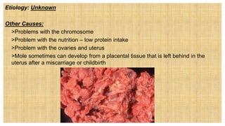 Etiology: Unknown
Other Causes:
 >Problems with the chromosome
 >Problem with the nutrition – low protein intake
 >Problem with the ovaries and uterus
 >Mole sometimes can develop from a placental tissue that is left behind in the
uterus after a miscarriage or childbirth
 