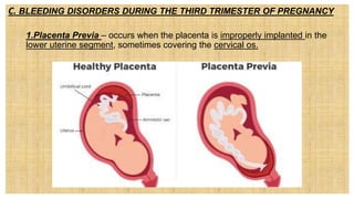 C. BLEEDING DISORDERS DURING THE THIRD TRIMESTER OF PREGNANCY
1. 1.Placenta Previa – occurs when the placenta is improperly implanted in the
lower uterine segment, sometimes covering the cervical os.
 