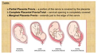 Types:
a. a.Partial Placenta Previa – a portion of the cervix is covered by the placenta
b. b.Complete Placental Previa/Total – cervical opening is completely covered
c. c.Marginal Placenta Previa – extends just to the edge of the cervix
 