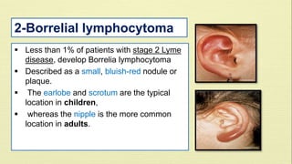 2-Borrelial lymphocytoma 
 Less than 1% of patients with stage 2 Lyme 
disease, develop Borrelia lymphocytoma 
 Described as a small, bluish-red nodule or 
plaque. 
 The earlobe and scrotum are the typical 
location in children, 
 whereas the nipple is the more common 
location in adults. 
 