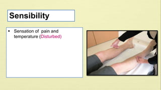 Sensibility 
 Sensation of pain and 
temperature (Disturbed) 
 