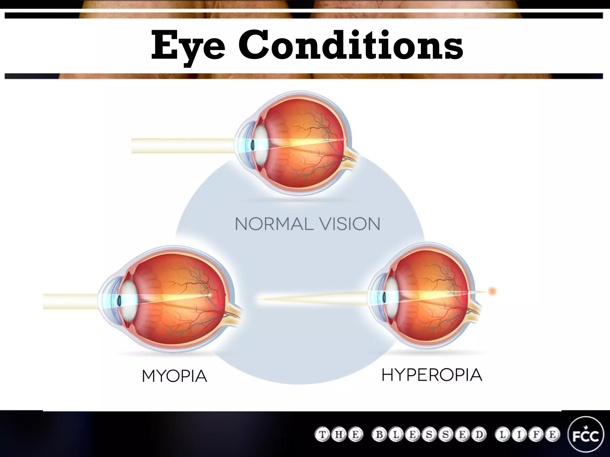 Eye Conditions
 
