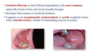 week+3+lect+3+-first+lect+Exophytic+Oral+Lesions.pdf