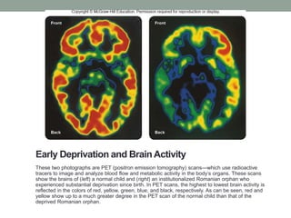 Early Deprivation and BrainActivity
These two photographs are PET (positron emission tomography) scans—which use radioactive
tracers to image and analyze blood flow and metabolic activity in the body’s organs. These scans
show the brains of (left) a normal child and (right) an institutionalized Romanian orphan who
experienced substantial deprivation since birth. In PET scans, the highest to lowest brain activity is
reflected in the colors of red, yellow, green, blue, and black, respectively. As can be seen, red and
yellow show up to a much greater degree in the PET scan of the normal child than that of the
deprived Romanian orphan.
Courtesy of Dr. Harry T. Chugani, Children’s Hospital of Michigan
 