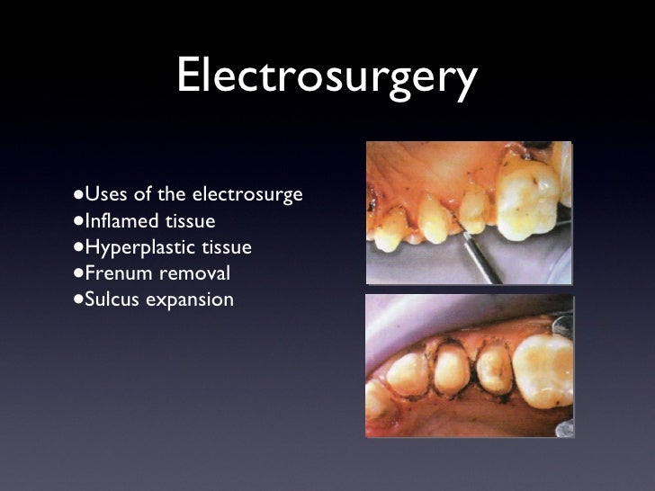 Tissue Management & Impression Technique