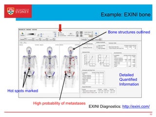 Example: EXINI bone
EXINI Diagnostics: http://exini.com/
53
Detailed
Quantified
Information
Bone structures outlined
Hot spots marked
High probability of metastases
 