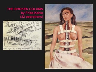 THE BROKEN COLUMN by Frida Kahlo (32 operations) 