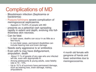 Complications of MD
• Bloodstream infection (Septicemia or

bacteremia)
• Purpura fulminans severe complication of
meningococcal septicaemia.
• Appears in 15-25% of people with MD

• presents as a petechial rash spreading

rapidly in extent and depth, evolving into fullthickness skin necrosis.
• Can be fatal.
• In fatal cases, deaths can occur in as little as a

few hours.
• In non-fatal cases, permanent disabilities can
include hearing loss and brain damage

• Needs early aggressive tx w/ antibiotics
• Even with tx may have disfigurement,

amputation, death
• About 11 % of people of any age who are infected

will die, even with appropriate tx .
• Among adolescents & young adults, case fatality
rate is 10 - 14%.
• Up to 19 % of survivors have permanent damage,
such as hearing loss, brain damage, kidney,
amputations

4 month old female with
gangrene of hands and
lower extremities due to
meningococcemia.

 
