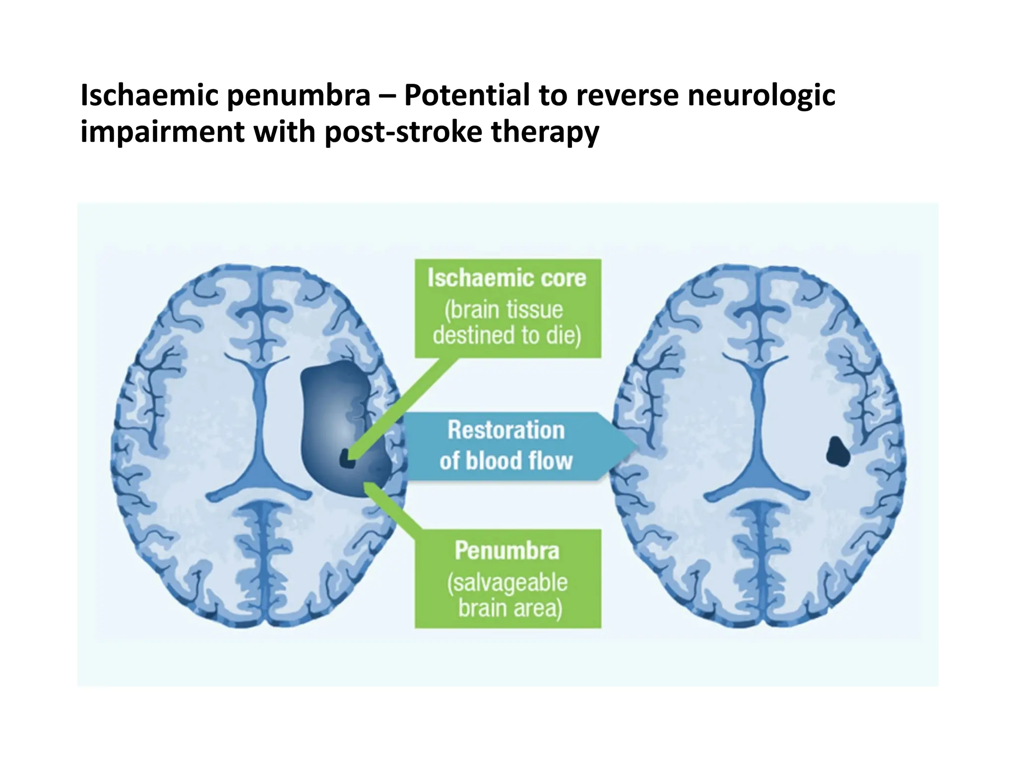 Ischaemic penumbra – Potential to reverse neurologic
impairment with post-stroke therapy
 