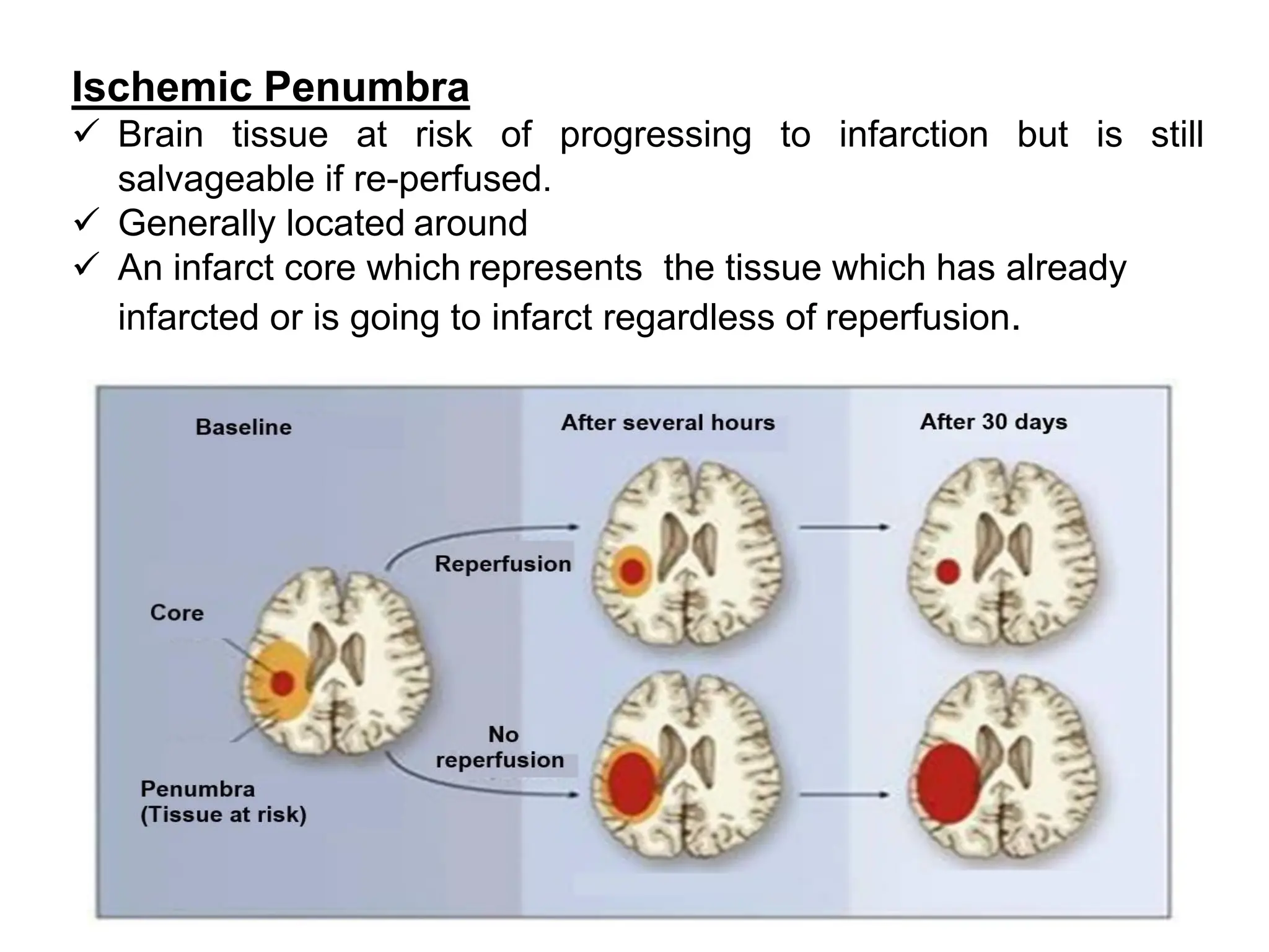 Ischemic Penumbra
✓ Brain tissue at risk of progressing to infarction but is still
salvageable if re-perfused.
✓ Generally located around
✓ An infarct core which represents the tissue which has already
infarcted or is going to infarct regardless of reperfusion.
 