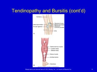 Mosby items and derived items © 2012 Mosby, Inc., an imprint of Elsevier Inc. 13
Tendinopathy and Bursitis (cont’d)
 