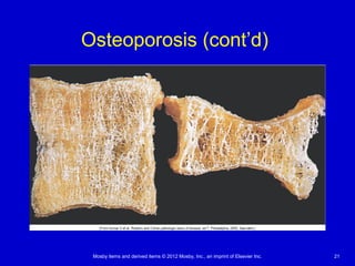 Mosby items and derived items © 2012 Mosby, Inc., an imprint of Elsevier Inc. 21
Osteoporosis (cont’d)
 