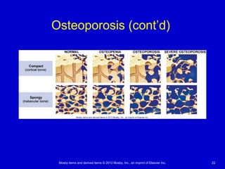 Mosby items and derived items © 2012 Mosby, Inc., an imprint of Elsevier Inc. 22
Osteoporosis (cont’d)
 