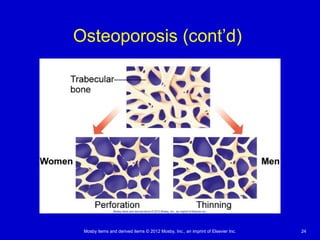 Mosby items and derived items © 2012 Mosby, Inc., an imprint of Elsevier Inc. 24
Osteoporosis (cont’d)
 