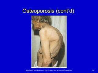 Mosby items and derived items © 2012 Mosby, Inc., an imprint of Elsevier Inc. 26
Osteoporosis (cont’d)
 
