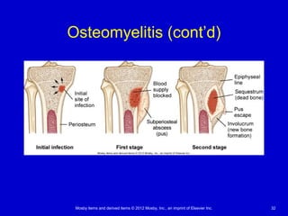 Mosby items and derived items © 2012 Mosby, Inc., an imprint of Elsevier Inc. 32
Osteomyelitis (cont’d)
 