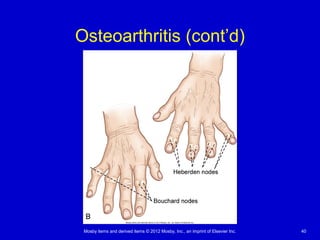 Mosby items and derived items © 2012 Mosby, Inc., an imprint of Elsevier Inc. 40
Osteoarthritis (cont’d)
 