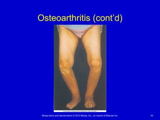 Mosby items and derived items © 2012 Mosby, Inc., an imprint of Elsevier Inc. 42
Osteoarthritis (cont’d)
 