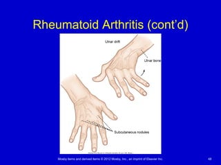 Mosby items and derived items © 2012 Mosby, Inc., an imprint of Elsevier Inc. 48
Rheumatoid Arthritis (cont’d)
 