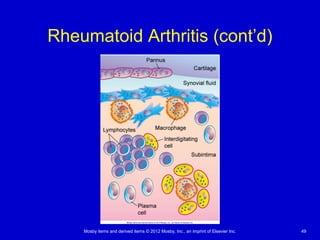 Mosby items and derived items © 2012 Mosby, Inc., an imprint of Elsevier Inc. 49
Rheumatoid Arthritis (cont’d)
 