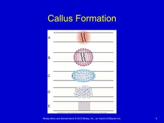 Mosby items and derived items © 2012 Mosby, Inc., an imprint of Elsevier Inc. 5
Callus Formation
 
