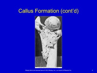 Mosby items and derived items © 2012 Mosby, Inc., an imprint of Elsevier Inc. 6
Callus Formation (cont’d)
 